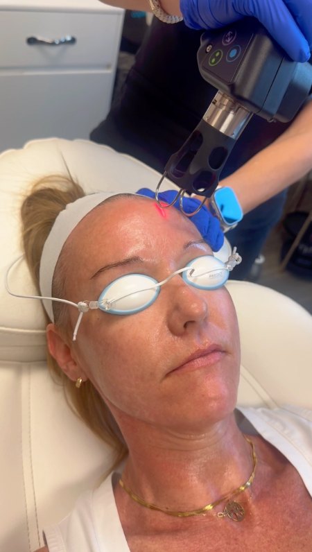 BayMed laser ad